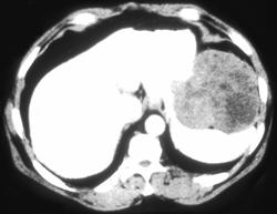 Gastric Leiomyosarcoma - CTisus CT Scan