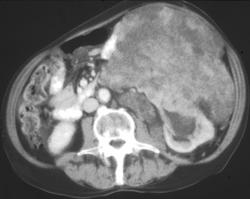 Gastric Leiomyosarcoma - CTisus CT Scan