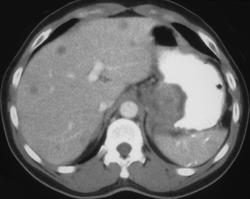 Gastric Cancer - CTisus CT Scan