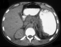 Recurrent Gastric Lymphoma - CTisus CT Scan