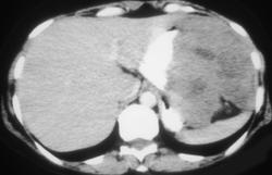 Gastric Leiomyosarcoma - CTisus CT Scan