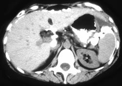 Carcinomatosis Due to Calcified Metastases From Ovarian Cancer - CTisus CT Scan