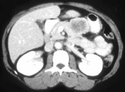 Gastric Leiomyoma - CTisus CT Scan