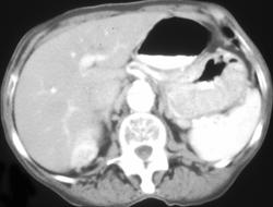 Gastric Pseudotumor in Fundus - CTisus CT Scan