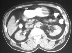 Gastric Leiomyoma - CTisus CT Scan