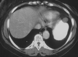 Gastric Leiomyoma - CTisus CT Scan