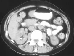 H. Pylori Stomach - CTisus CT Scan