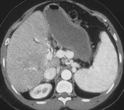 Gastric Varices - CTisus CT Scan