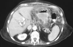 Gastritis Due to Radiation Therapy. Portal Vein Thrombosis W/ Cavernous Transformation of Portal Vein Also Seen - CTisus CT Scan