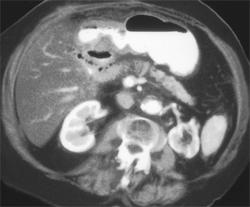 Radiation Gastritis - CTisus CT Scan