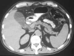 Cryptosporidiosis of the Stomach in An AIDS Patient - CTisus CT Scan