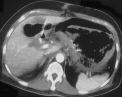 Emphysematous Gastritis With Perforation - CTisus CT Scan