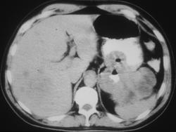 Ulcerating Gastric Cancer - CTisus CT Scan