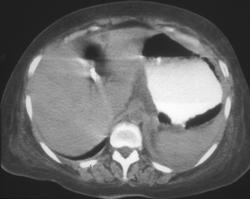 Gastric Emphysema - CTisus CT Scan