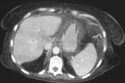 Gastritis - CTisus CT Scan