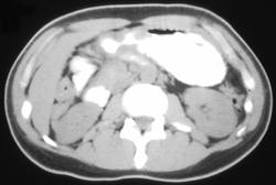 Ulcer in Gastric Lymphoma - CTisus CT Scan