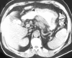 Gastric Lymphoma - CTisus CT Scan