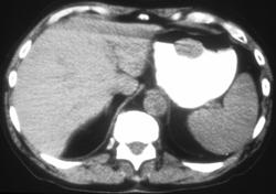 Gastric Leiomyoma - CTisus CT Scan