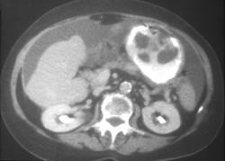 Gastric Metastases - CTisus CT Scan