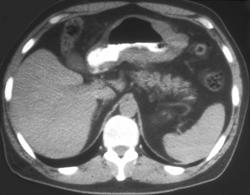 Gastric Lymphoma - CTisus CT Scan