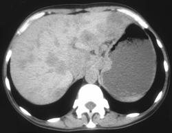 Subtle Gastric Cancer With Liver Metastases - CTisus CT Scan