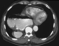 Gastric Volvulus - CTisus CT Scan