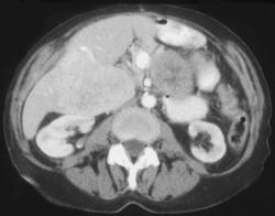 Gastric Leiomyosarcoma - CTisus CT Scan