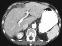 Metastatic Implants on the Stomach and Liver - CTisus CT Scan