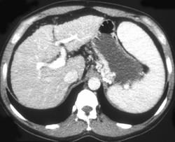 Gastric Varices (dual Phase- Seen Best in Portal Phase) - CTisus CT Scan