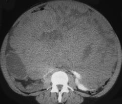 Gastric Leiomyosarcoma - CTisus CT Scan