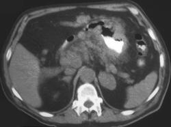 Gastric Cancer With Nodes and Adrenal Mets - CTisus CT Scan