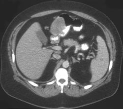 Gastric Leiomyosarcoma - CTisus CT Scan