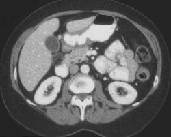 Gastric Adenocarcinoma - CTisus CT Scan