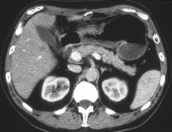 Early Gastric Cancer in Antrum - CTisus CT Scan