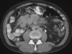 Recurrent Gastric Cancer in Mesenteric Nodes - CTisus CT Scan