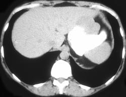 Gastric Leiomyoma - CTisus CT Scan