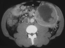 Gastric Leiomyosarcoma (w/ IVC Clot) - CTisus CT Scan