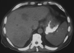 Ulcerating Adenocarcinoma of the Stomach - CTisus CT Scan