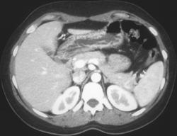 Gastritis - CTisus CT Scan