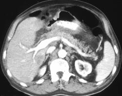 Gastric Carcinoma - CTisus CT Scan