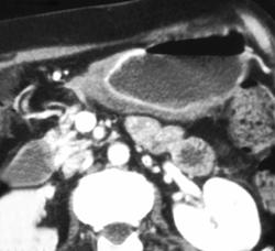 Gastric Lymphoma - CTisus CT Scan