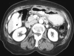 Gastric Adenocarcinoma - CTisus CT Scan