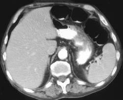 Gastric Ulcer - CTisus CT Scan