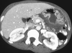 Gastric Cancer - CTisus CT Scan