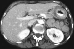 Linitis Plastica - CTisus CT Scan