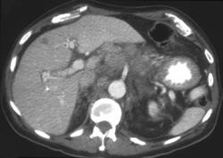 Gastric Lymphoma - CTisus CT Scan