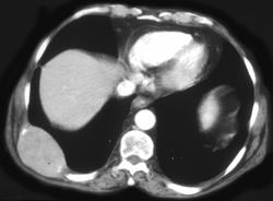 Gastric Cancer Metastatic to Bone - CTisus CT Scan