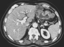 Gastric Carcinoma at Anastomosis of Stomach and Small Bowel - CTisus CT Scan