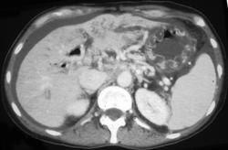 Severe Radiation Gastritis - CTisus CT Scan