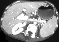 Otherwise Normal Stomach With Subtle Gastric Tumor (adenocarcinoma) - CTisus CT Scan